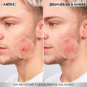 Quinta imatge del producte Pegats Acne Invisibles Pure Active de la marca GARNIER